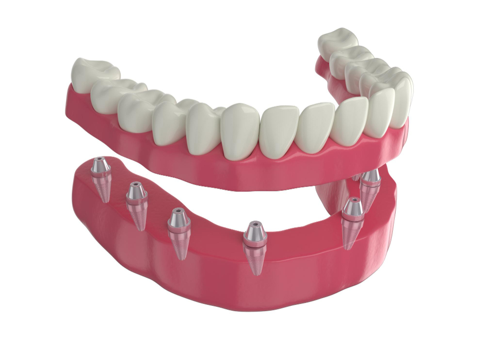 Demystifying The Cost Of All-On-4 Dental Implants