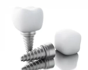 How Much do Tooth Implants Cost in Australia