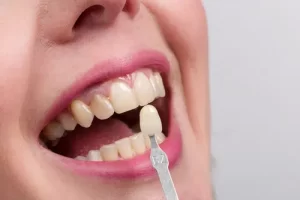 Why Get Cosmetic Dentistry Veneers