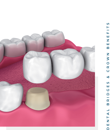 Dental Bridges Crown Benefits 1